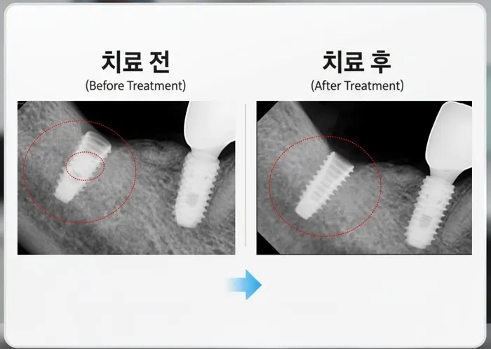 임플란트 어버트먼트 스크류가 부러진 케이스 상일동에서도 오시는 치과